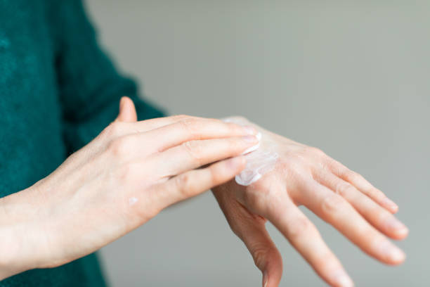 Az urea szerepe a kézkrémekben extra száraz bőrre