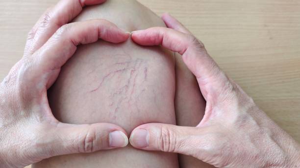 Legjobb visszér elleni krémek - Kiemelt kép